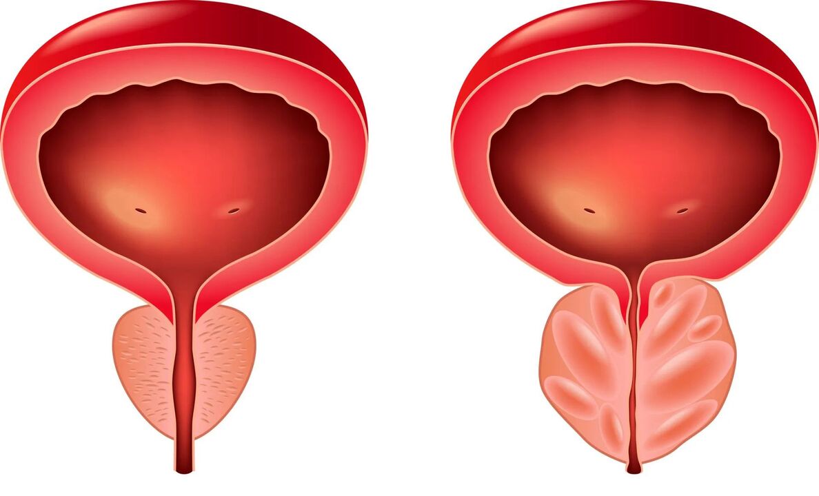 prostata normalna i chora